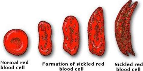10 Interesting Sickle Cell Anemia Facts My Interesting Facts