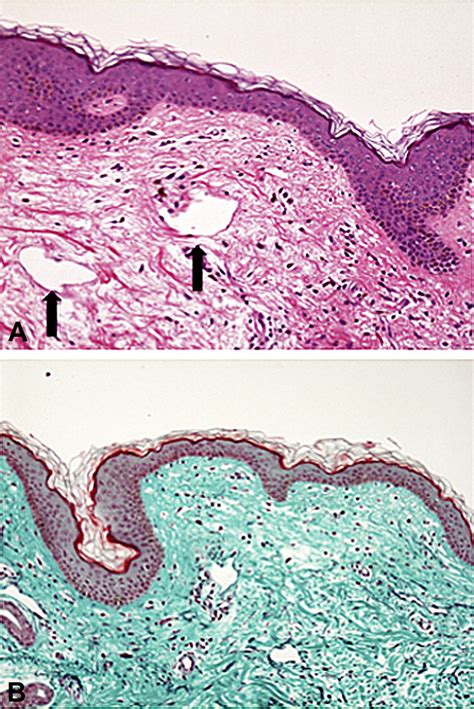 Dermoscopy Of Pseudoxanthoma Elasticum Like Papillary Dermal