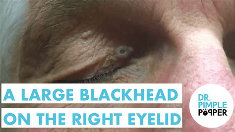 A Large Blackhead On The Right Eyelid Maybe Even A Dilated Pore Of