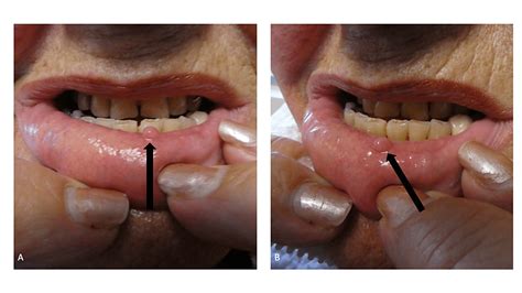Cureus Biting Fibroma Of The Lower Lip A Case Report And Literature
