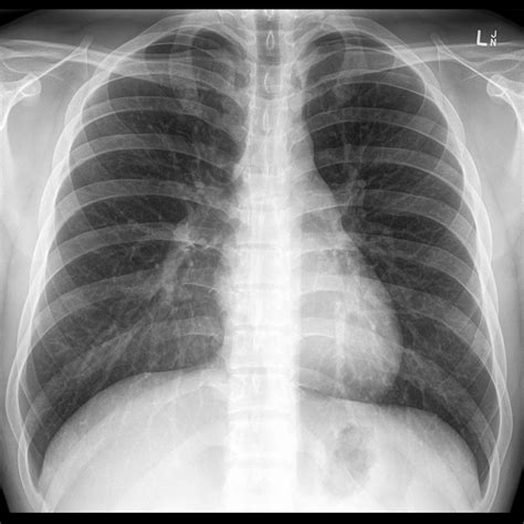 Normal Frontal Chest X Ray Image