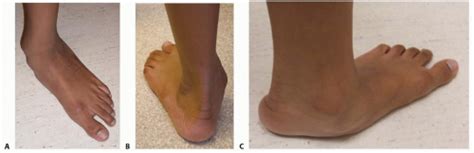 Calcaneal Lengthening Osteotomy For The Treatment Of Hindfoot Valgus