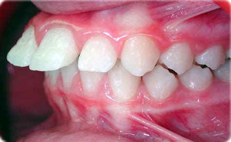 Common Orthodontic Problems Clinical And Radiographic Wirant
