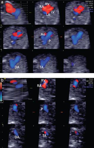 First‐trimester Fetal Cardiac Examination Using Spatiotemporal Image