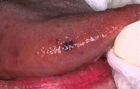 Dark Spots On Tongue Tip Side Back Or Under Causes Skincarederm