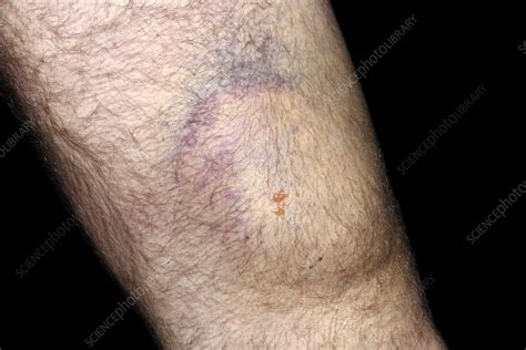Haematoma On Leg Following An Accident Stock Image C0532638