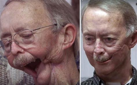 A 3d Printed Jaw Has Given This Cancer Survivor A New Face People