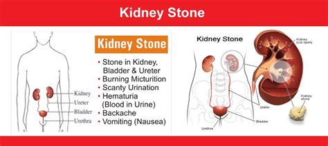 Calculus Kidney Stone Dr Gyan Homoeopathic Hospital And Research Centre