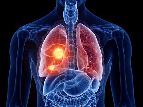 Lung Cancer Symptoms Causes And Treatment Of Lung Can