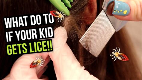 What To Do If Your Kid Gets Head Lice Youtube