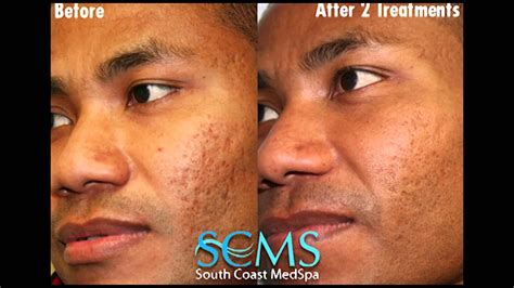 Beforeafter African American Male Laser Acne Scar Removal Results
