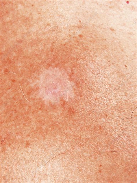 Basal Cell Carcinoma Stock Image C0254622 Science Photo Library
