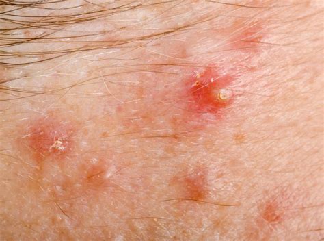 What Is Pityrosporum Folliculitis With Pictures
