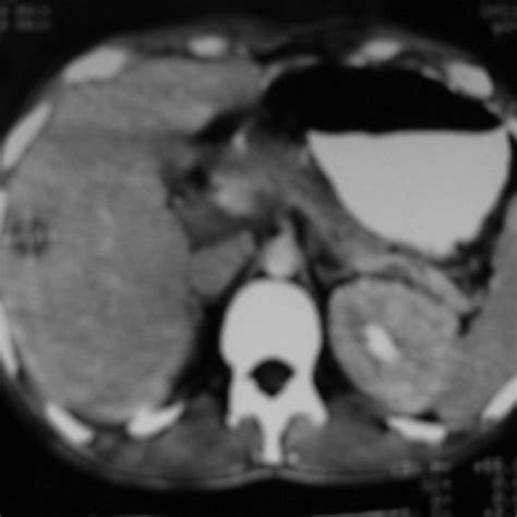 Abdominal Lymphadenopathy Download Scientific Diagram