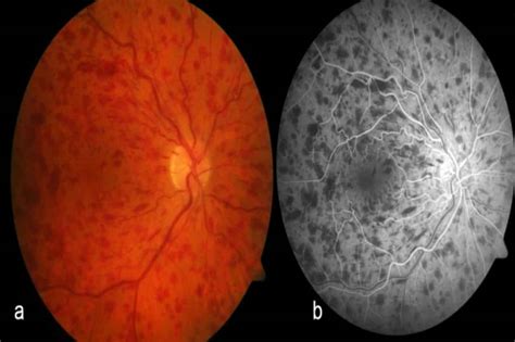 Oclusión De Arteria Central De Retina Área Oftalmológica