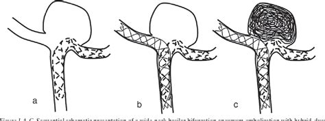 Figure 2 From Y Stent Assisted Coil Embolization Of Wide Neck