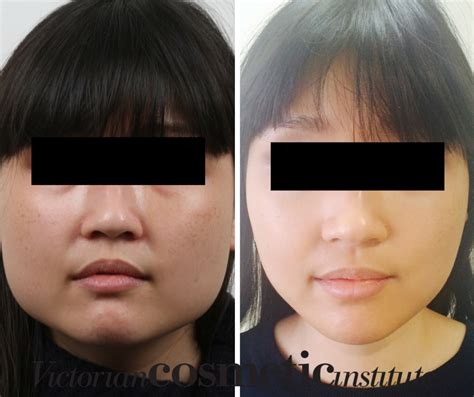 Face Slimming Surgery Before And After Of Removal Face Slimming Btx