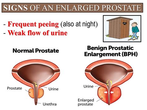What can i take for an enlarged prostate