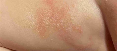 What Is Diaper Rash Symptoms Treatment And Tips To Prevent Raising Families Naturally