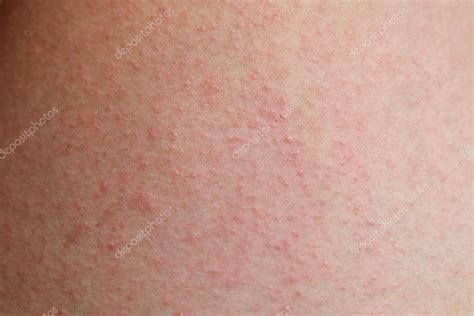 Éruption Cutanée Allergique Dermatite Peau Du Patient Image Libre De