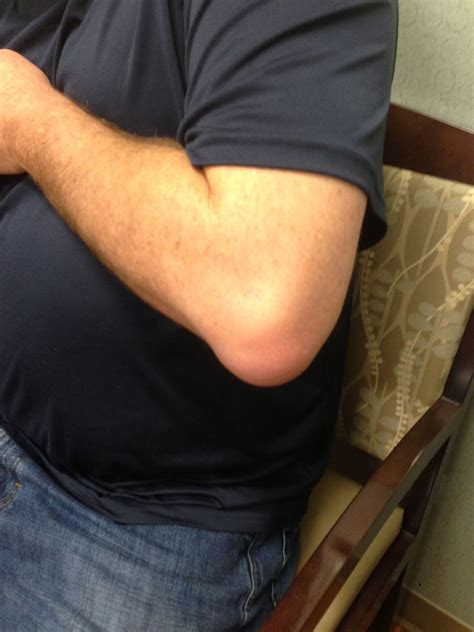 Olecranon Bursitis Signs Symptoms And Treatment Of The Elbow Problem