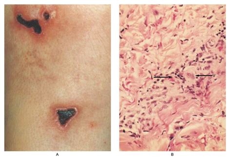 Severe Necrotizing Cutaneous Lesions Complicating Treatment With