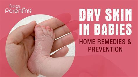 Baby Dry Skin Causes Remedies And Prevention Youtube