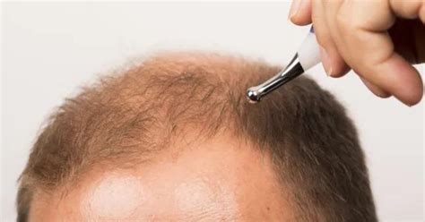 Surgical Vs Non Surgical Hair Replacement Pros And Cons Of Each Kiwiwell
