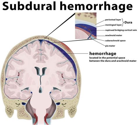 Epidural Hematoma Causes Signs Symptoms Diagnosis Treatment