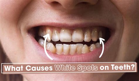How To Get Rid Of White Spots On Teeth Quickly How Can I Get Rid Of