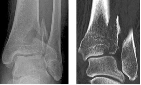 Bofas Hyperbook Radiology 5 Fractures