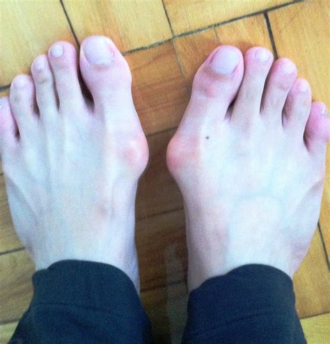 Do Bunions Cause Numbness In Toes Bunions Causes Symptoms And Treatment