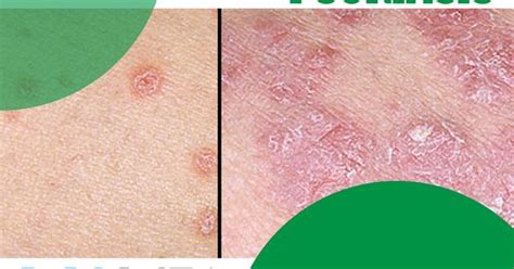 乾癬の写真：皮膚、爪などの乾癬のビジュアルガイド 皮膚の問題 と トリートメント 2024