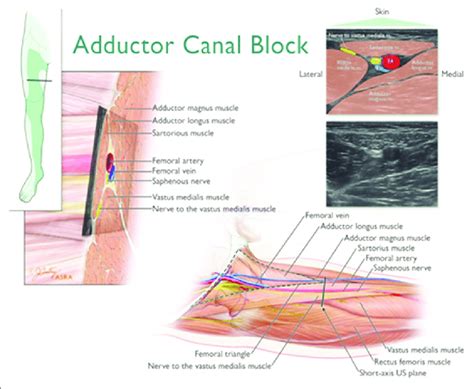 Adductor Canal Block Image Adapted From American Society Of Regional