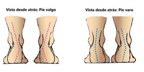 Plantillas ortopédicas en Zaragoza a medida patologias