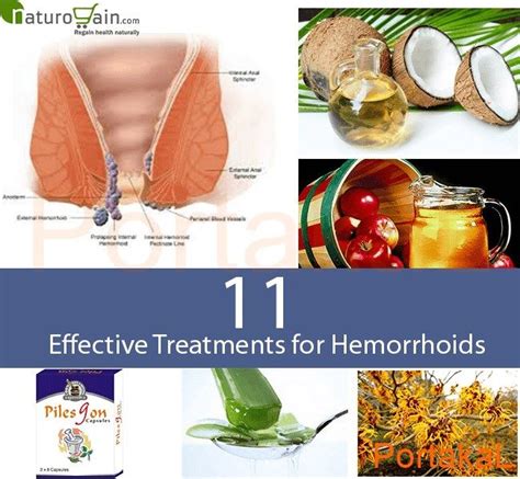 15 natural remedies in 2020 hemorrhoids natural headache remedies hemorrhoid remedies
