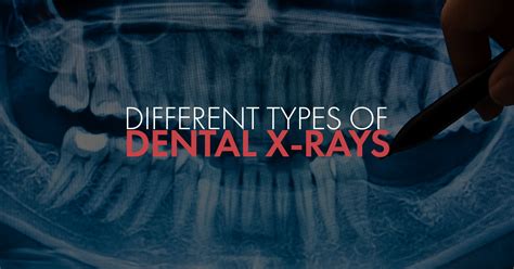 Different Types Of Dental X Rays Epic Dental Blog