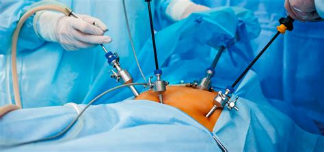 4 Benefícios Da Cirurgia Digestiva Videolaparoscópica Cirurgião Do
