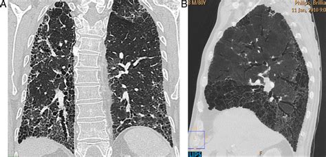 Fibrosis Pulmonar Idiopática Con Patrón Típico De Neumonía Intersticial