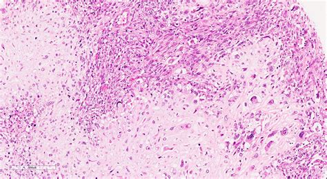 Myoepithelioma Myoepithelial Carcinoma Mixed Tumor Blog
