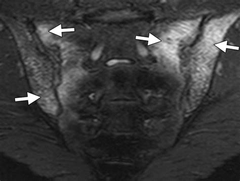 Sacroiliitis Associated With Axial Spondyloarthropathy New Concepts