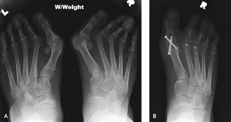 Management Of Complications After Correction Of Hallux Valgus Plastic