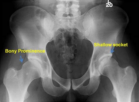 Pao Surgery For Hip Dysplasia In An Active 25 Year Old Male St Louis