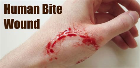 If the bite area develops redness, swelling, puffiness, pain or a discharge, seek what is sepsis and how do doctors treat it? How To Tell if a Human Bite Wound is Infected?