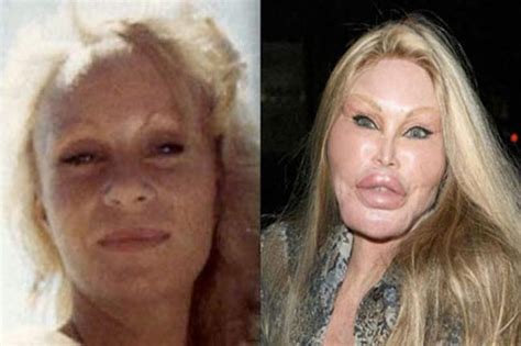 Want A Horror Story Here Are 5 Plastic Surgeries That Went Horribly