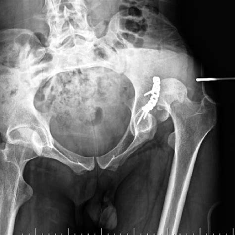 Left Hip Traumatic Fracture Dislocation Anterioposterio View