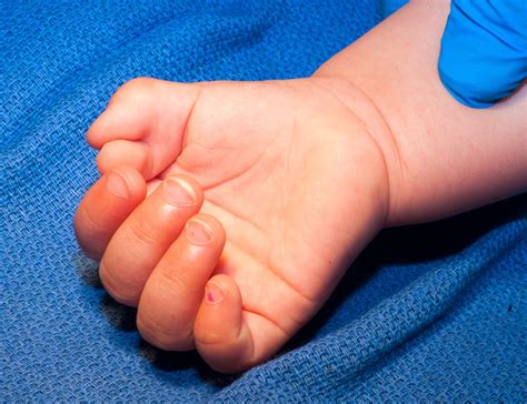The Extra Thumb Congenital Hand And Arm Differences