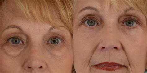 Eyelid Surgery Blepharoplasty Before And After Pictures Case 69