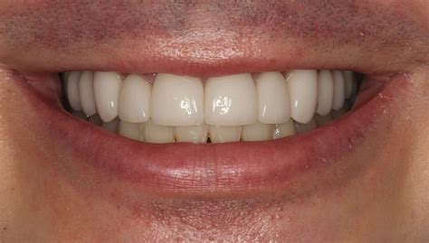 Before And After Porcelain Veneers And Smile Makeover And Full Mouth
