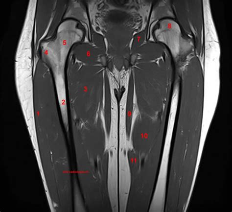 Mri Of The Thigh Detailed Anatomy Superior Part W Radiology